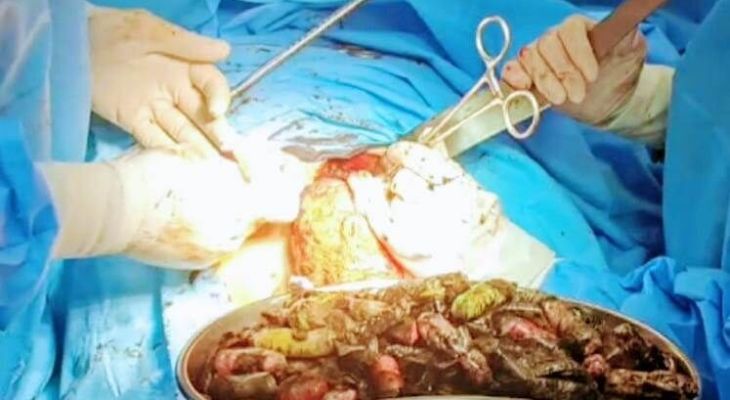 خارج‌کردن ۹۰ بسته موادمخدر از معده یک‌فرد کرجی