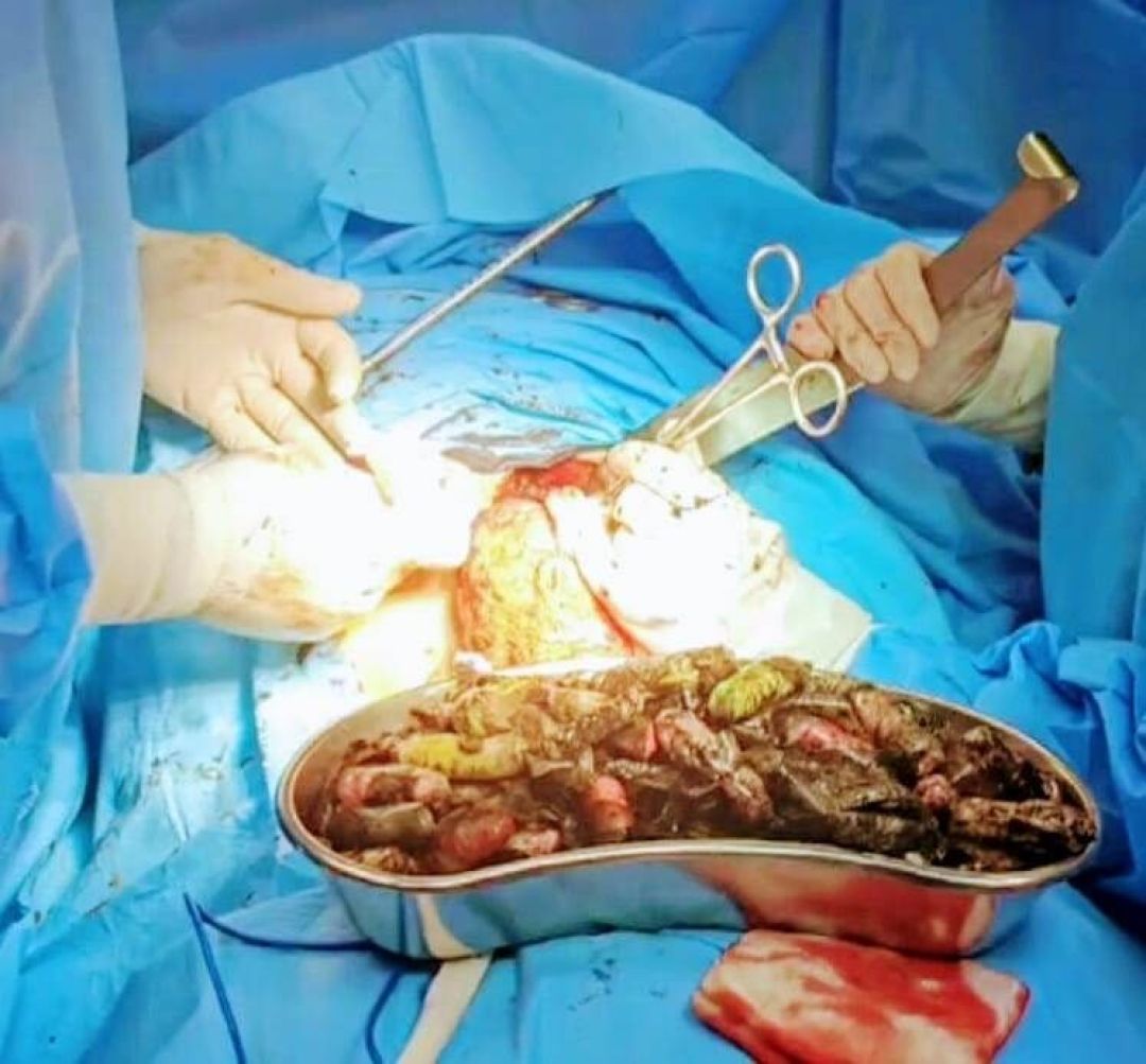 خارج‌کردن ۹۰ بسته موادمخدر از معده یک‌فرد کرجی